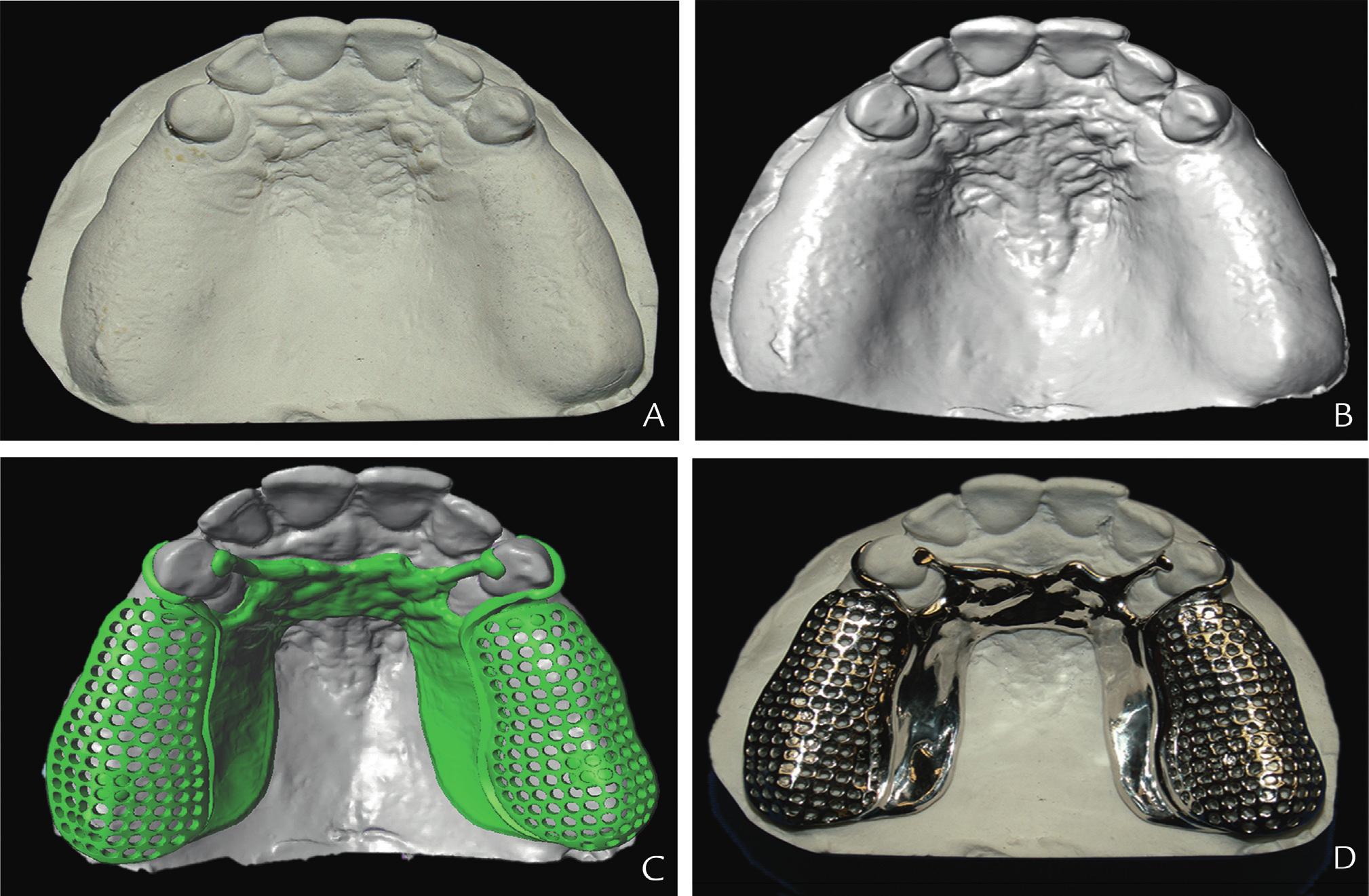 3D Printed Dentures