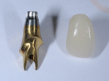 Implant crown and Abutment (2)
