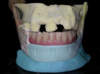 Mandible rebuild (1)