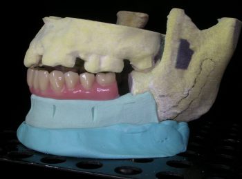 Mandible rebuild (2)