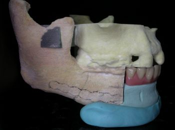 Mandible rebuild (3)
