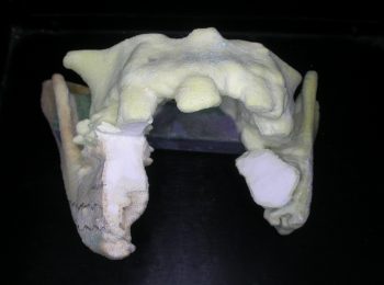 Mandible rebuild (4)