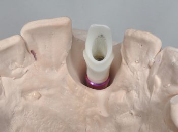 Zirconia Abutment (1)