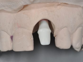 Zirconia Abutment (2)