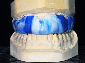 mouth guard 3