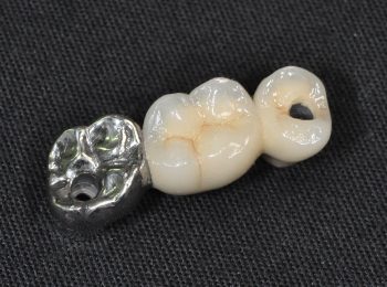 3 unit Implant bridge (1)