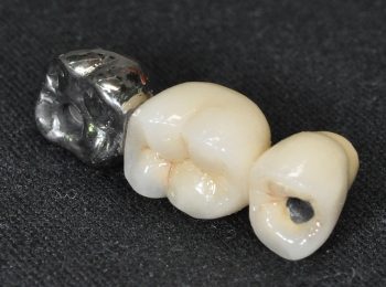 3 unit Implant bridge (2)
