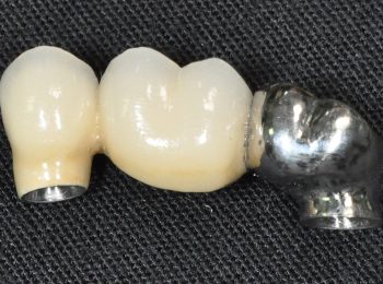3 unit Implant bridge (3)