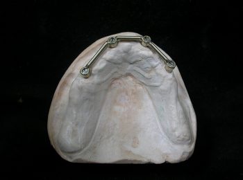 Implant over denture (2)