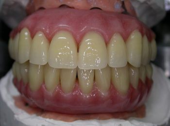 Upper and Lower Implant Temp Bridges