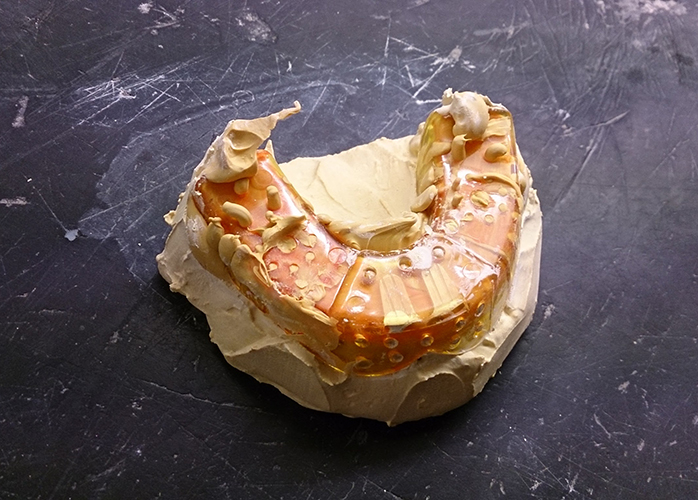 Plaster Cast Dental Models vs 3D Digital Models