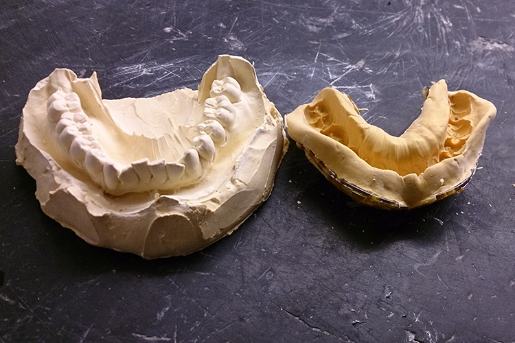 Plaster Cast Dental Models vs 3D Digital Models