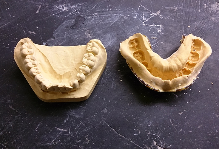 Plaster Cast Dental Models vs 3D Digital Models