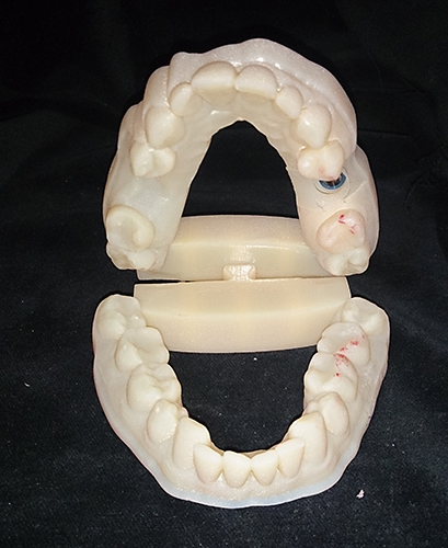 Plaster Cast Dental Models vs 3D Digital Models