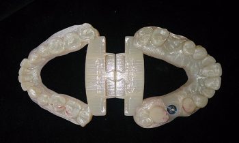 Plaster Cast Dental Models vs 3D Digital Models