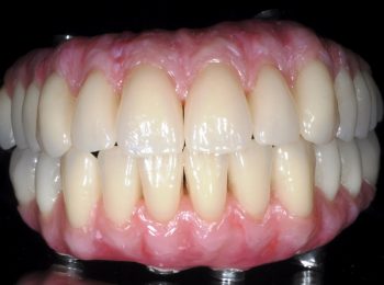 Implant Bridges - Nobel Biocare PIB bridges with Schottlander Enigma Gingival Composit